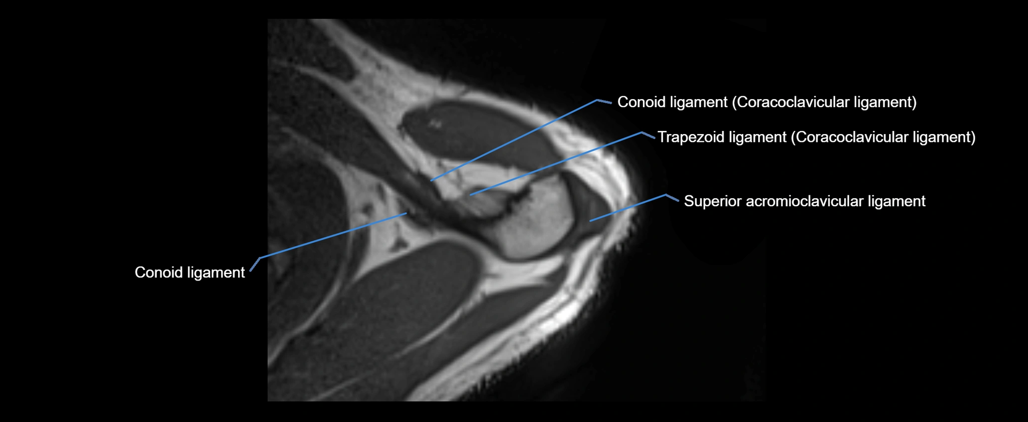 shoulder ligaments axial 3d 3t mri image-img-00005-00022.webp